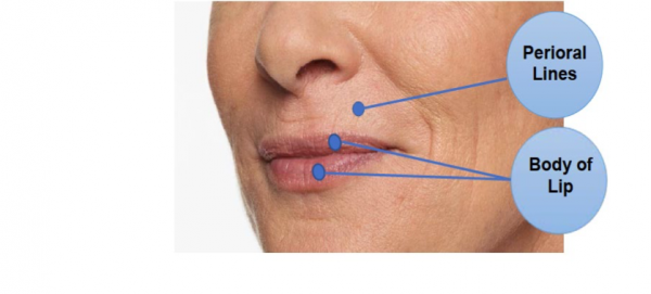 Shows the perioral lines and body of lips as it ages