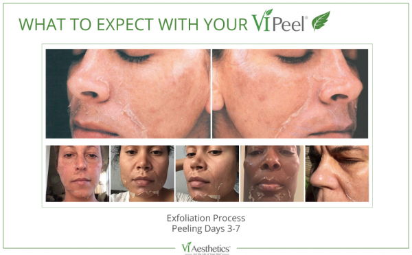 ViPeel Results