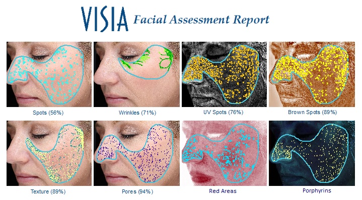 Visia Facial Assessment