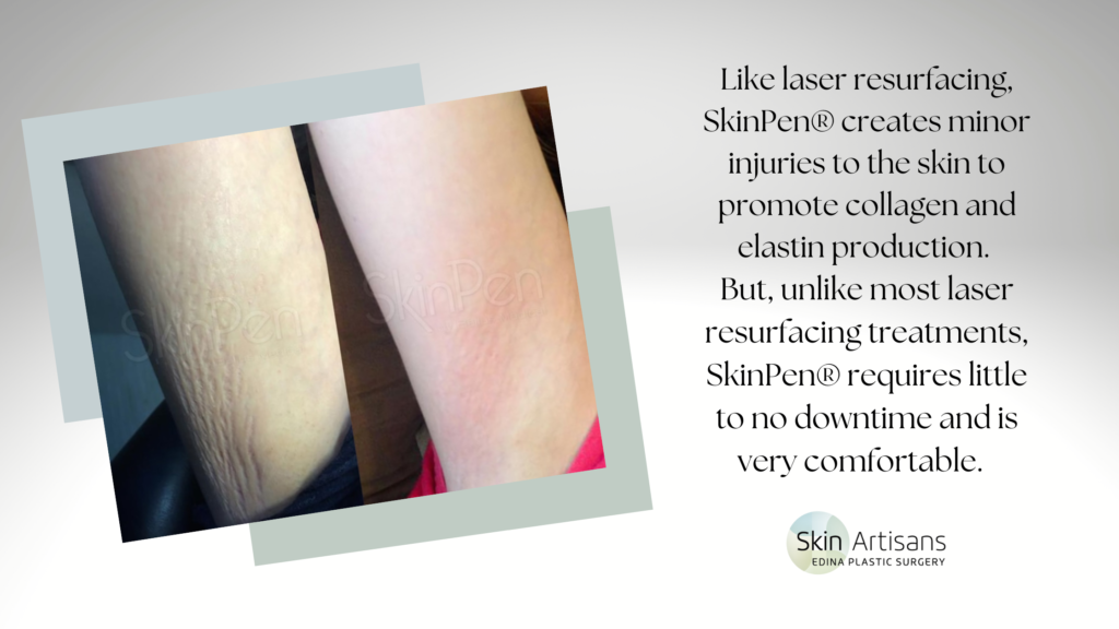 5 Non-Surgical Solutions that Can Improve the Appearance of Stretch ...