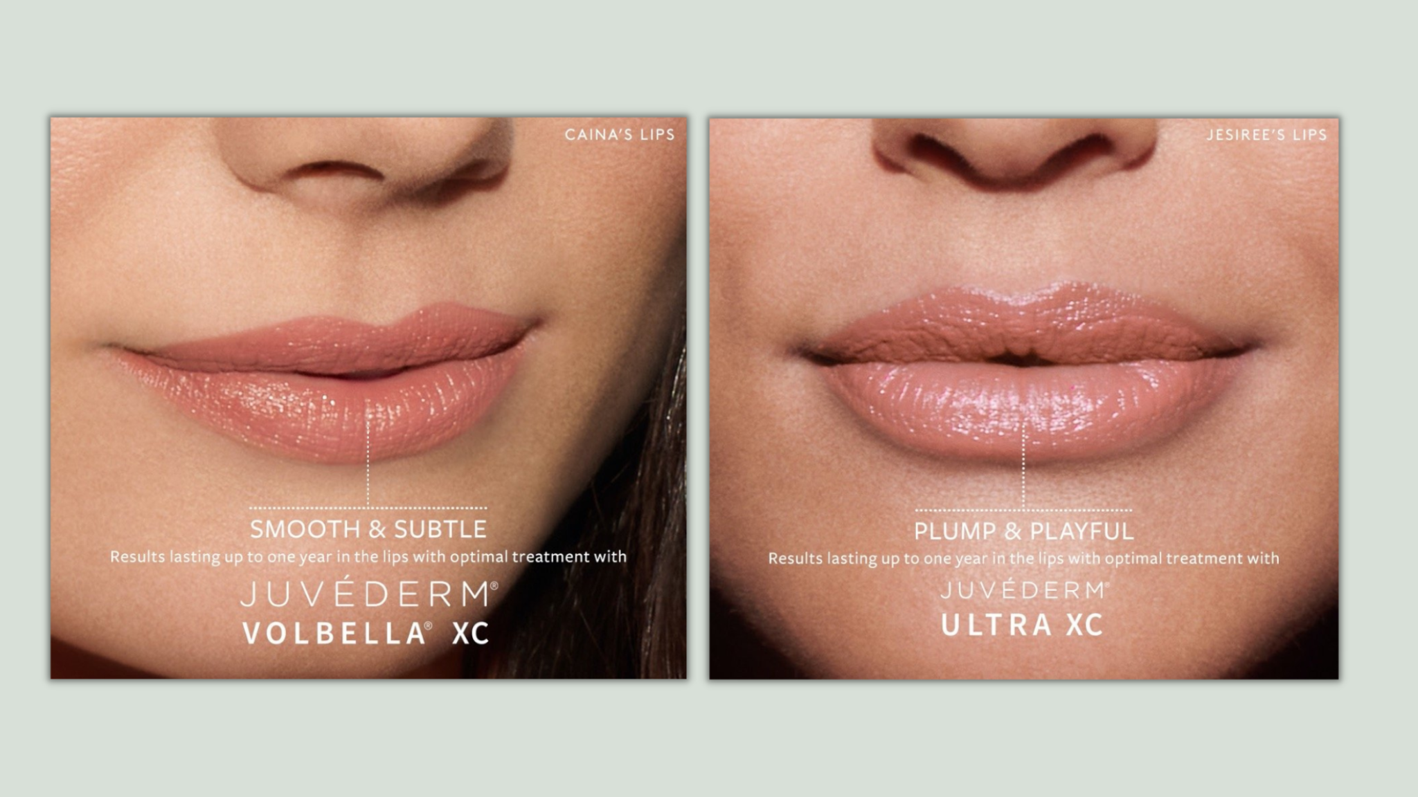 How Long Does Juvéderm® Last? - Skin Artisans