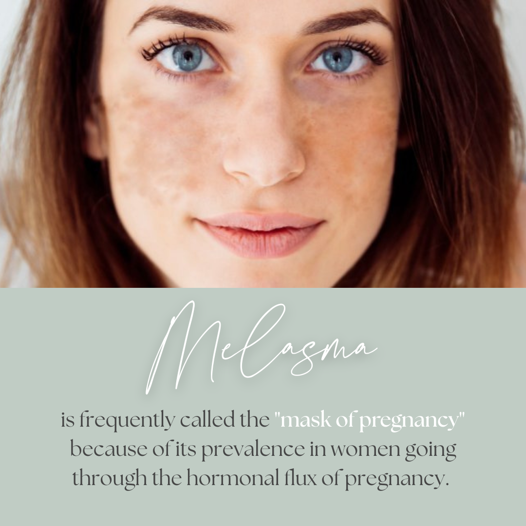 Get a Clear & Even Complexion with the Melasma Peel Skin Artisans