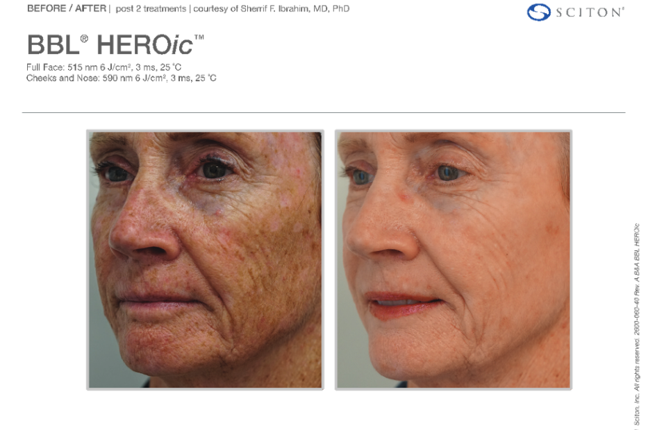The Full-Body Glow-Up: Why BBL HEROic Is the Ultimate Treatment for ...
